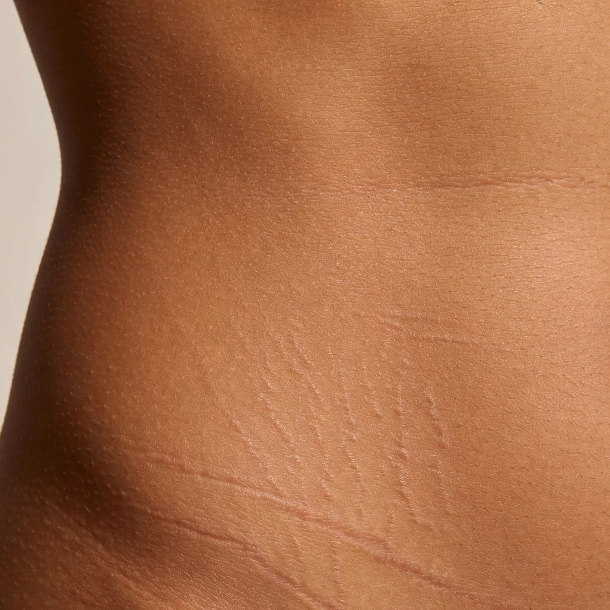 Stretch mark treatment