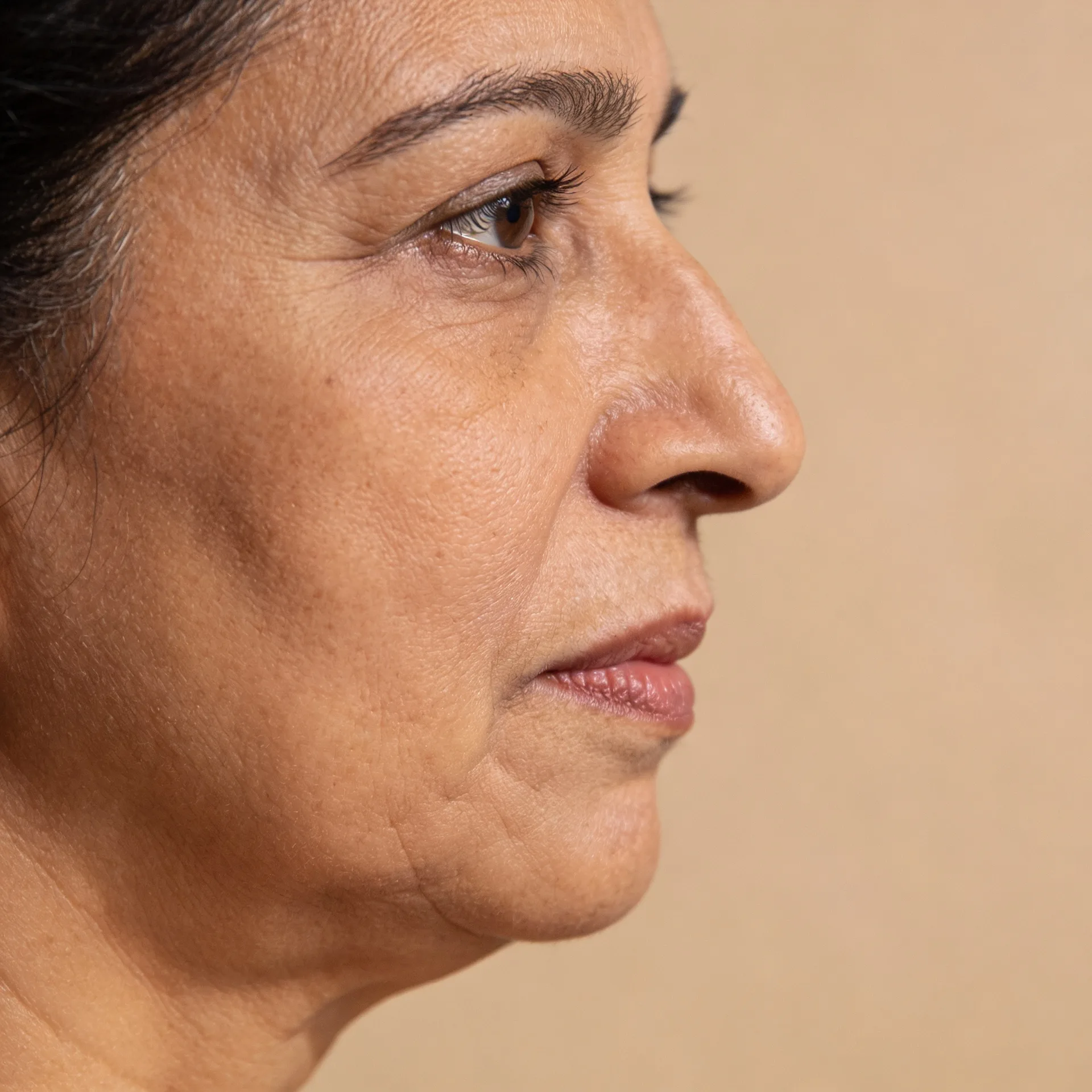 HIFU threads and derma lifting treatment