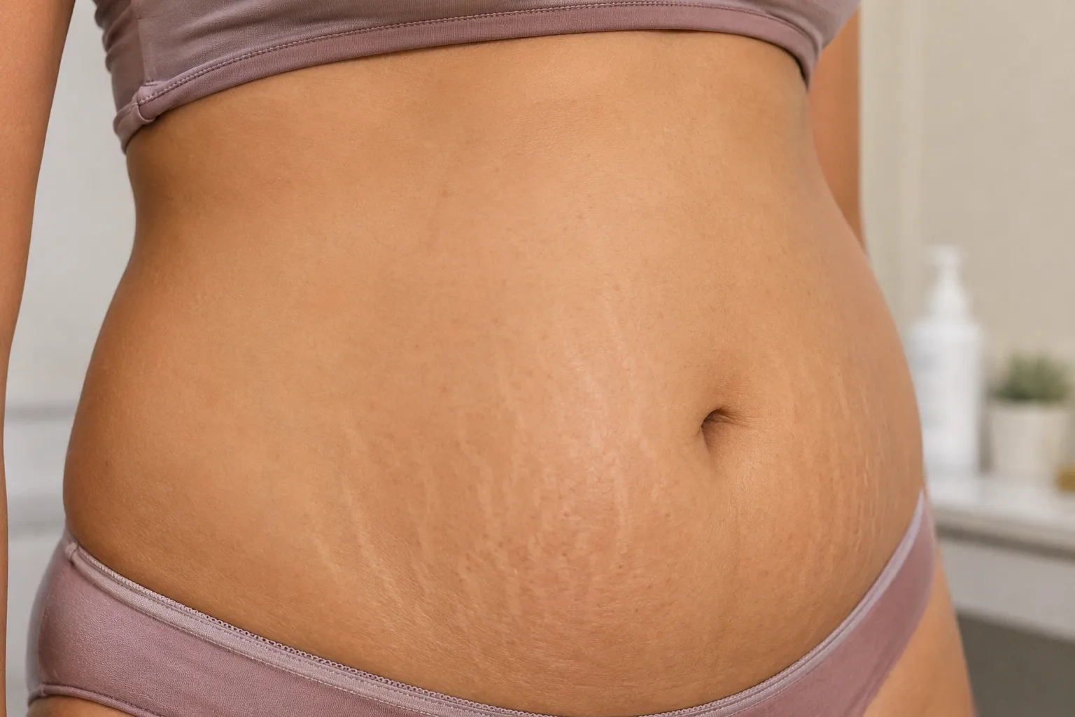 Stretch mark treatment