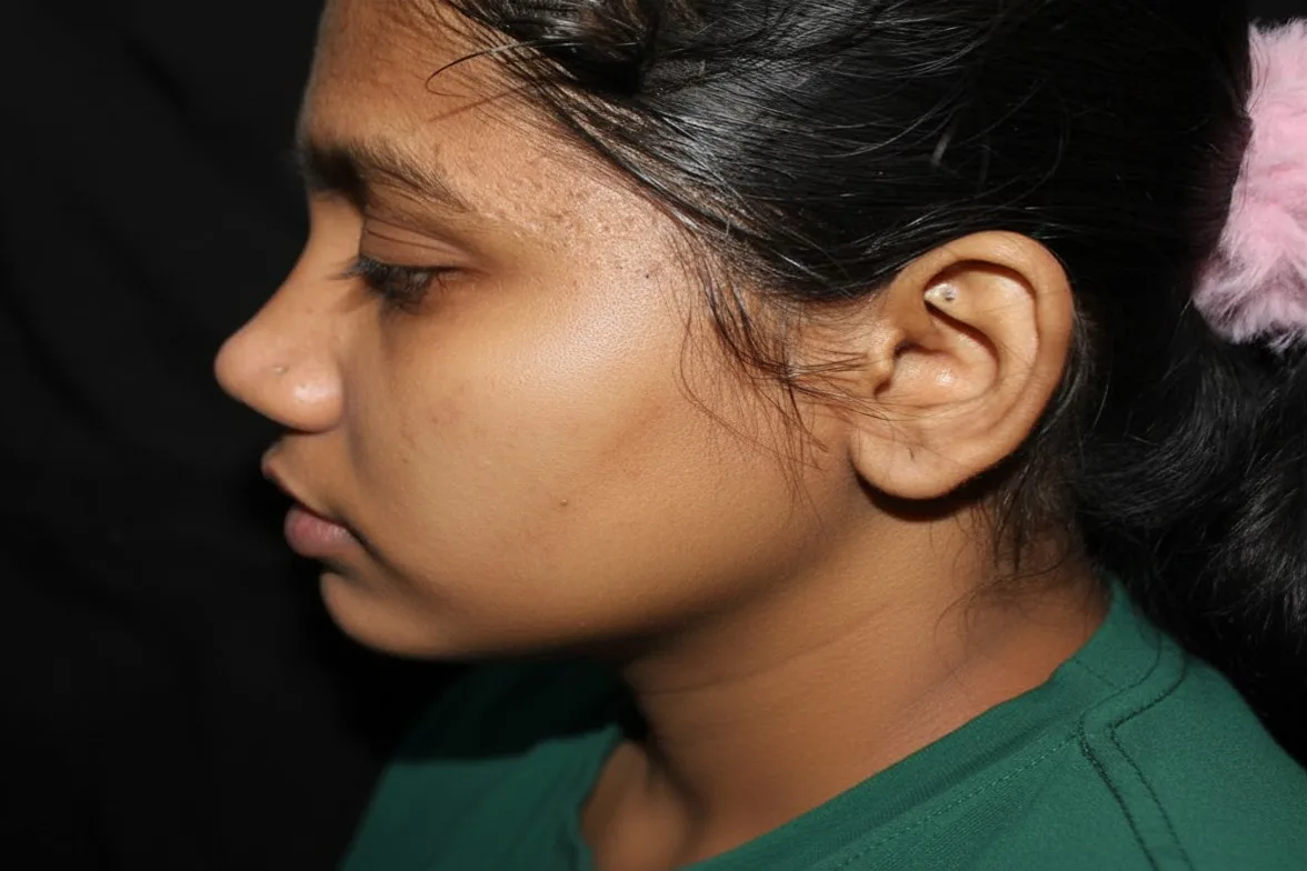 After skin brightening treatment result
