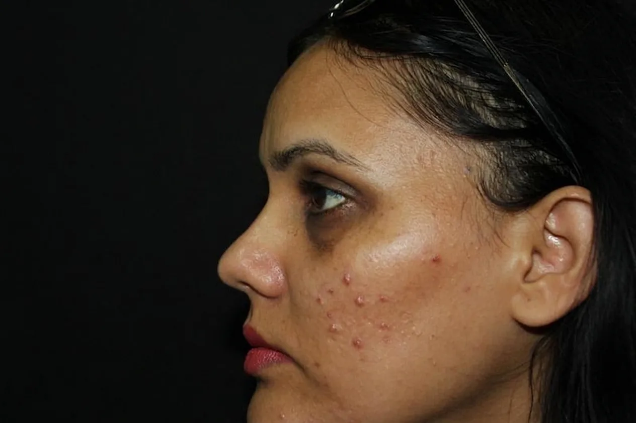 Before pigmentation treatment concern