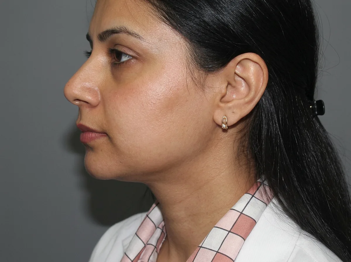 Before acne scar treatment concern