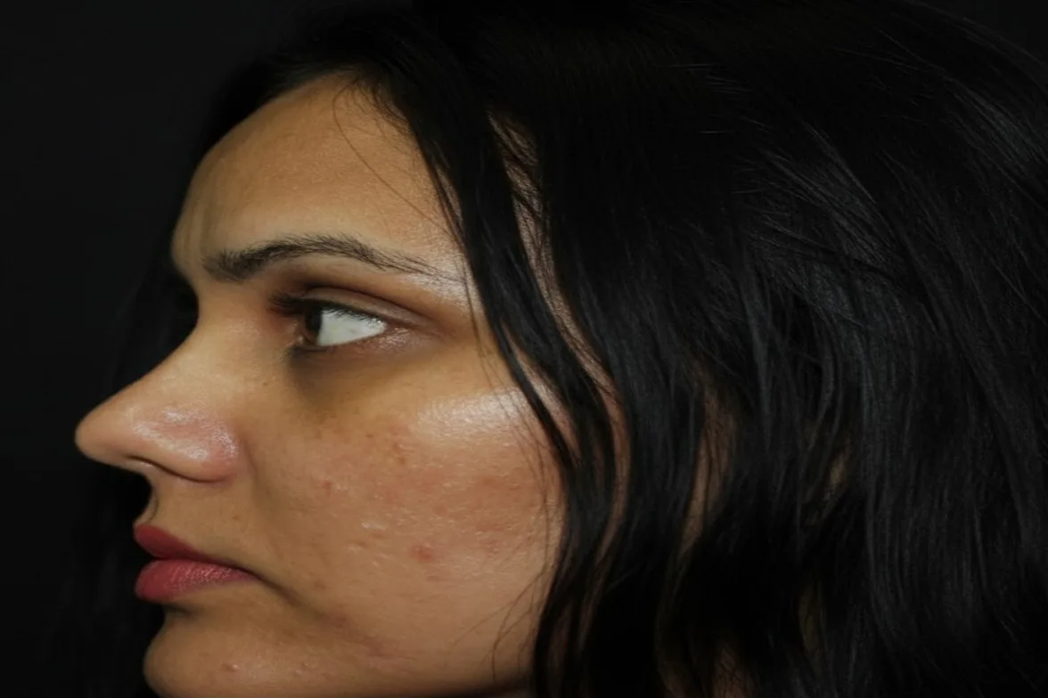After pigmentation treatment result